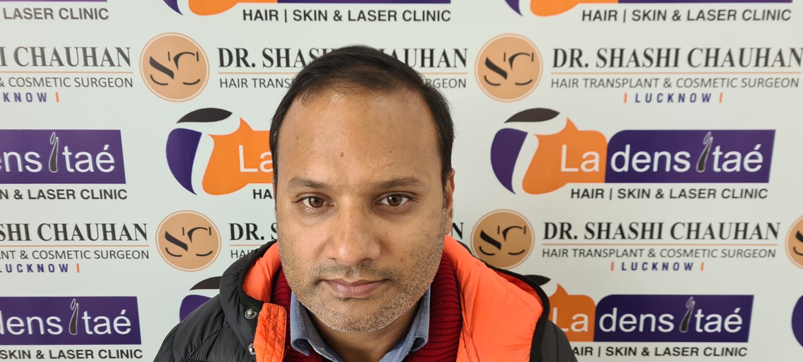 Rahul Agrawal Before Hair Transplant